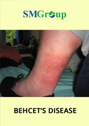Behcets Disease cover