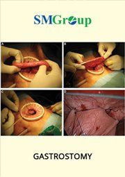 Gastrostomy cover